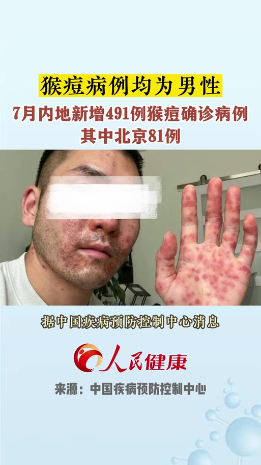 猴痘疫情最新消息/猴痘疫情最新消息2024