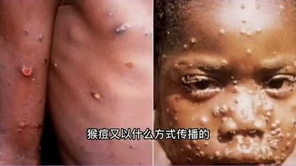 猴痘疫情最新消息/猴痘疫情最新消息2024-第2张图片 猴痘疫情最新消息/猴痘疫情最新消息2024-第2张图片